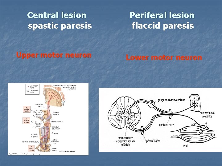 Central lesion Periferal lesion spastic paresis flaccid paresis Upper motor neuron Lower motor neuron