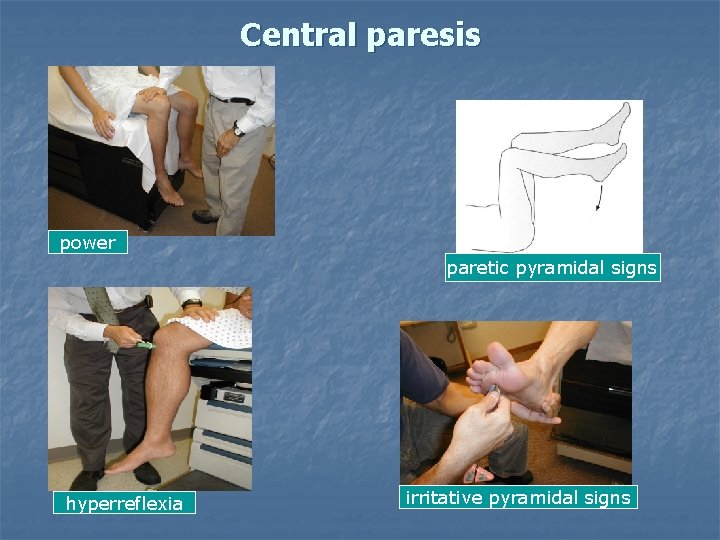 Central paresis power paretic pyramidal signs hyperreflexia irritative pyramidal signs 