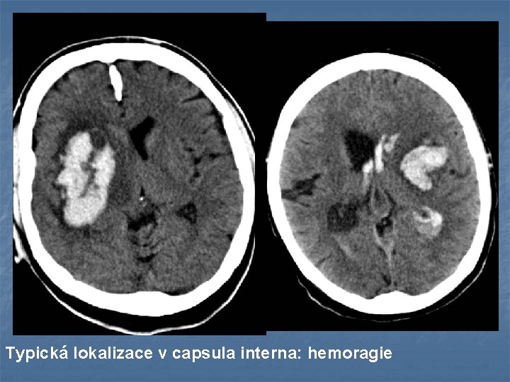 Typická lokalizace v capsula interna: hemoragie 