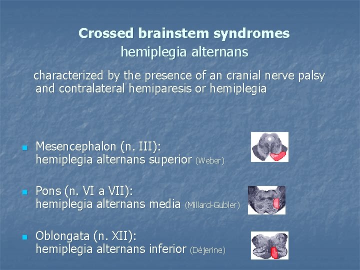 Crossed brainstem syndromes hemiplegia alternans characterized by the presence of an cranial nerve palsy