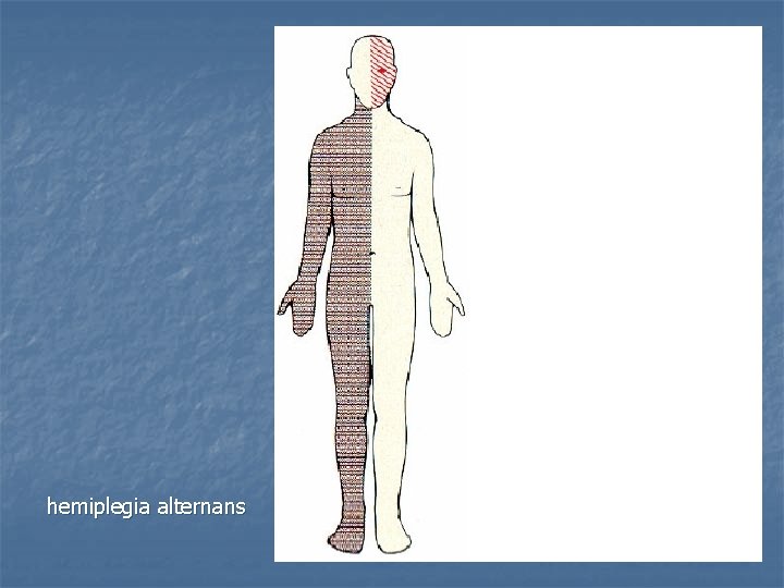 hemiplegia alternans 