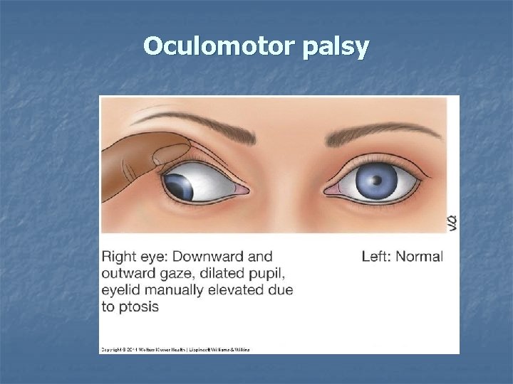 Oculomotor palsy 