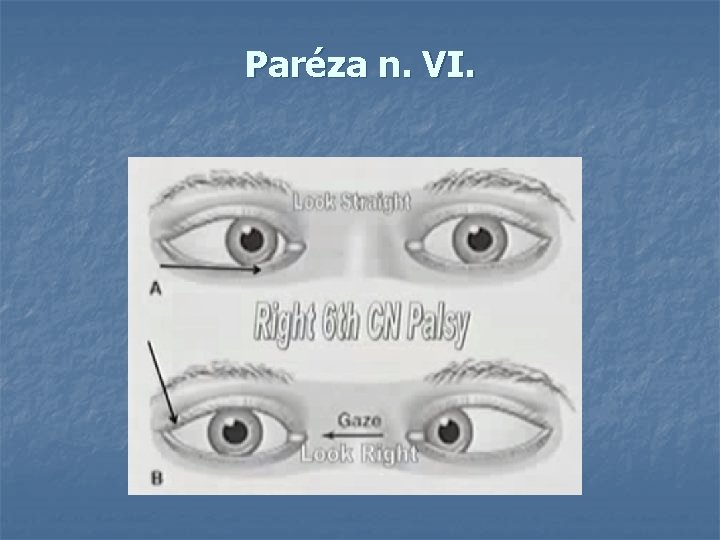 Paréza n. VI. 