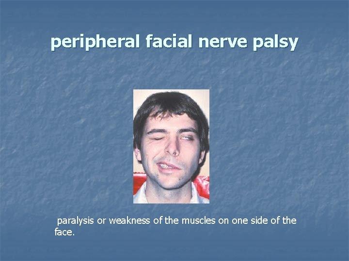 peripheral facial nerve palsy paralysis or weakness of the muscles on one side of