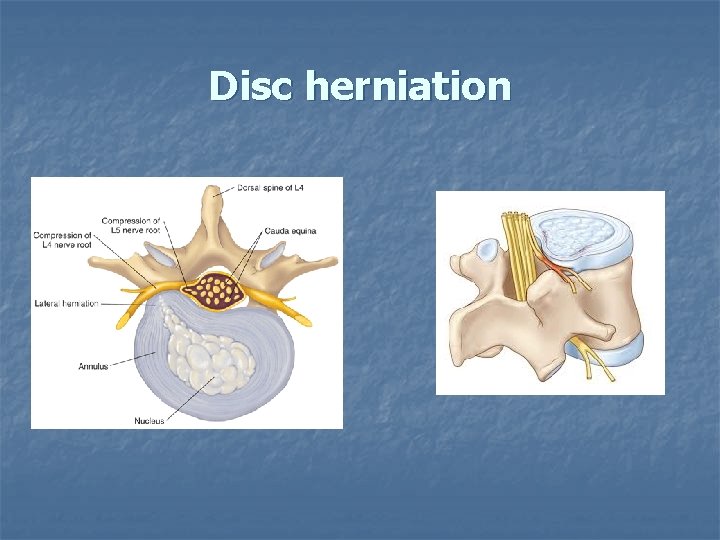 Disc herniation 