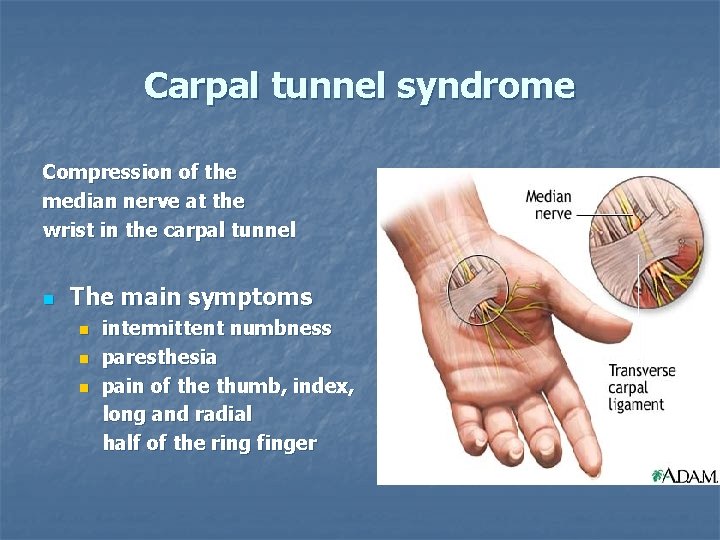 Carpal tunnel syndrome Compression of the median nerve at the wrist in the carpal