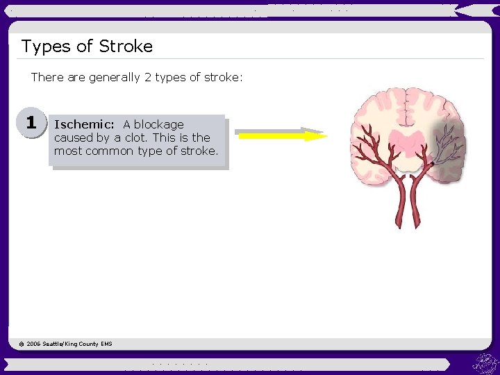 Types of Stroke There are generally 2 types of stroke: 1 Ischemic: A blockage