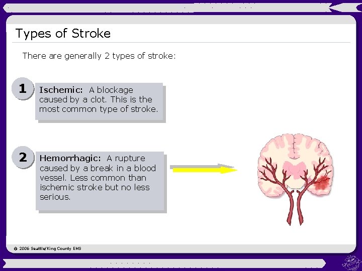 Types of Stroke There are generally 2 types of stroke: 1 Ischemic: A blockage