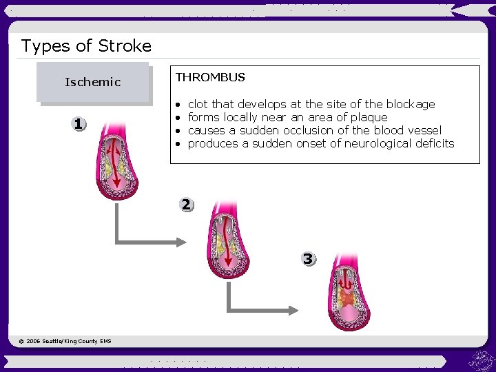 Types of Stroke Ischemic 1 THROMBUS • • clot that develops at the site