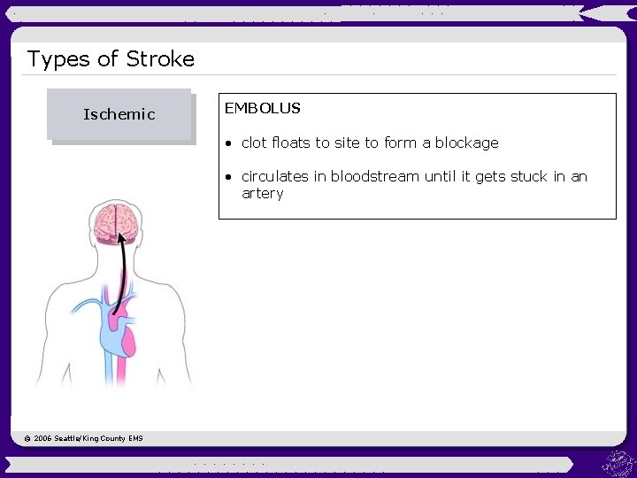 Types of Stroke Ischemic EMBOLUS • clot floats to site to form a blockage
