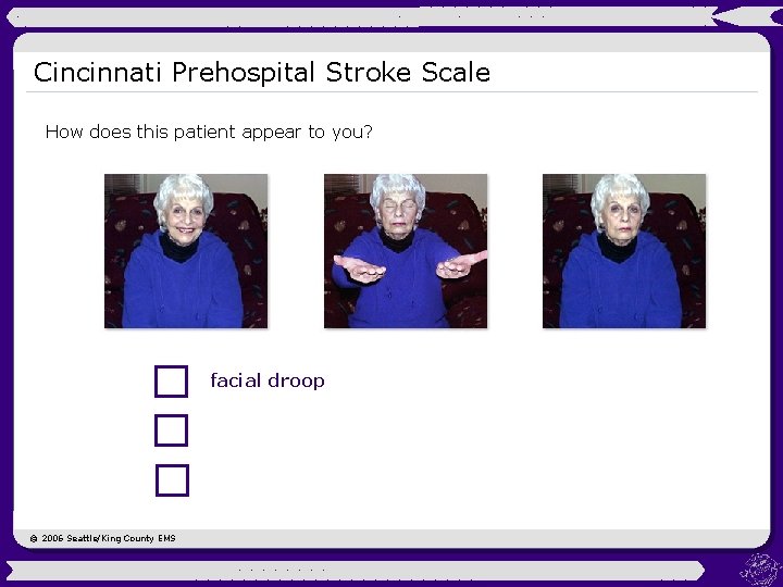 Cincinnati Prehospital Stroke Scale How does this patient appear to you? facial droop ©