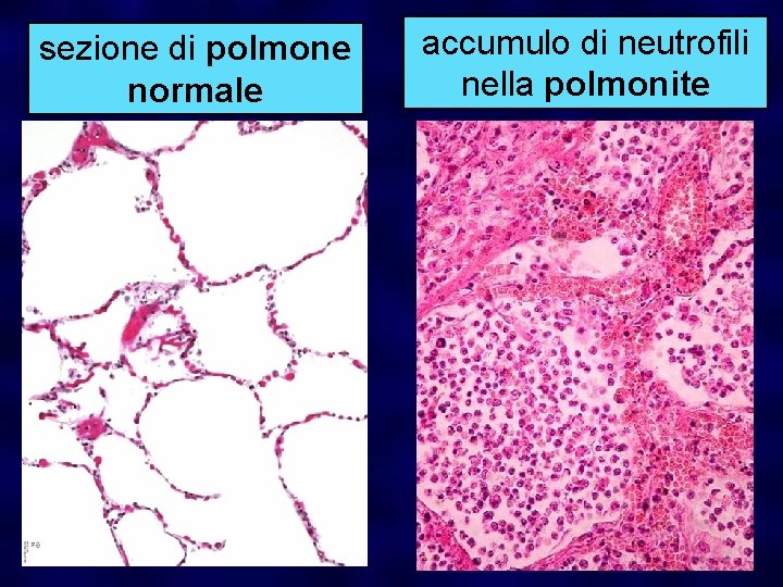 sezione di polmone normale accumulo di neutrofili nella polmonite 
