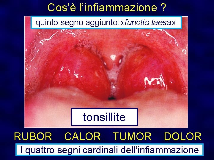 Cos’è l’infiammazione ? quinto segno aggiunto: «functio laesa» tonsillite RUBOR CALOR TUMOR DOLOR I