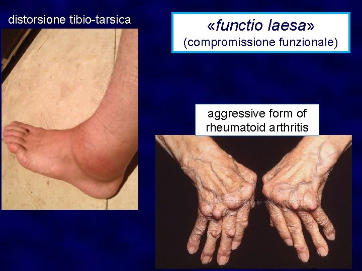 distorsione tibio-tarsica «functio laesa» (compromissione funzionale) aggressive form of rheumatoid arthritis 