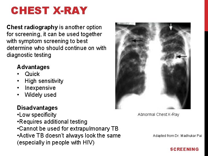 CHEST X-RAY Chest radiography is another option for screening, it can be used together