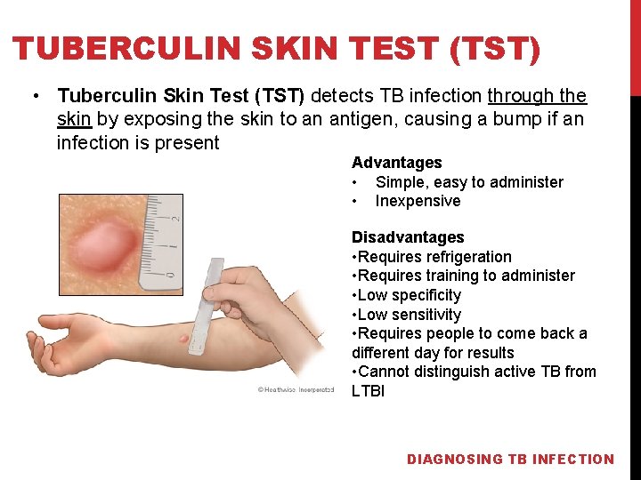 TUBERCULIN SKIN TEST (TST) • Tuberculin Skin Test (TST) detects TB infection through the