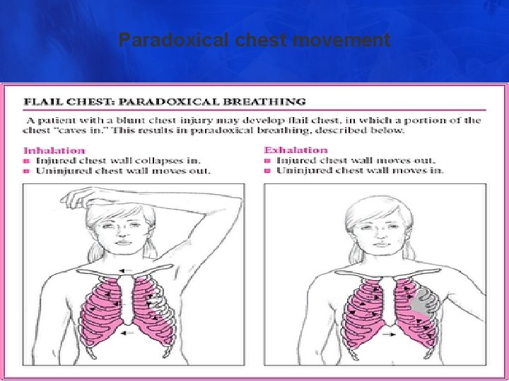 Paradoxical chest movement 