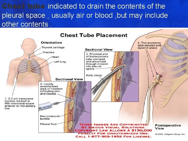Chest tube indicated to drain the contents of the pleural space , usually air