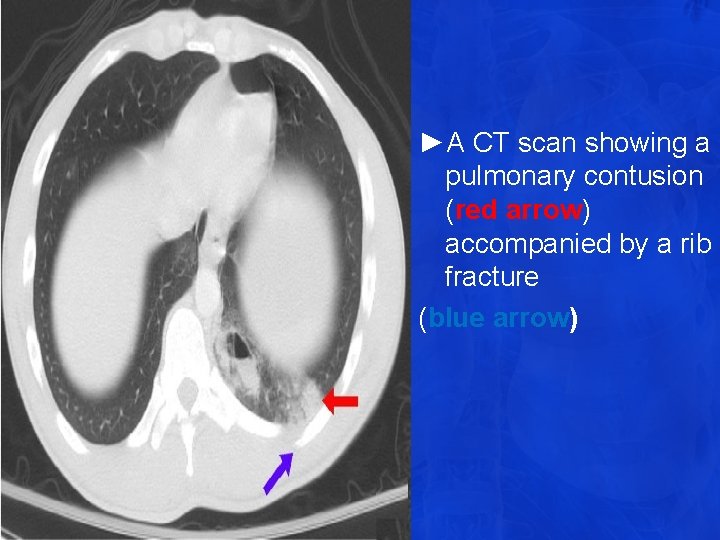 ►A CT scan showing a pulmonary contusion (red arrow) accompanied by a rib fracture