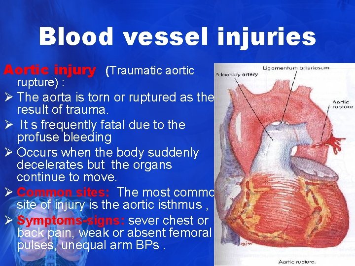 Blood vessel injuries Aortic injury (Traumatic aortic rupture) : Ø The aorta is torn