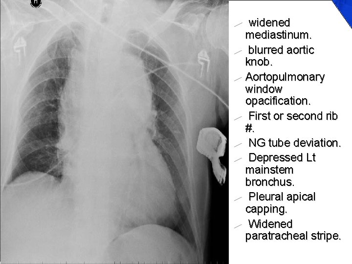 ► widened mediastinum. ► blurred aortic knob. ► Aortopulmonary window opacification. ► First or