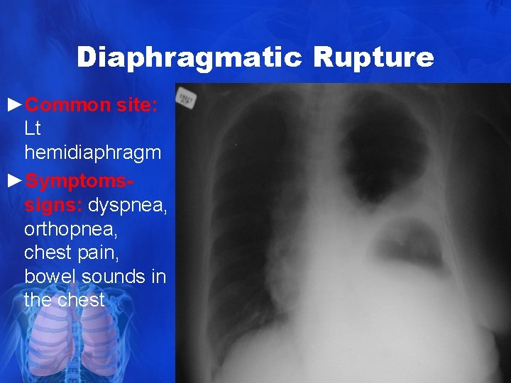 Diaphragmatic Rupture ►Common site: Lt hemidiaphragm ►Symptomssigns: dyspnea, orthopnea, chest pain, bowel sounds in