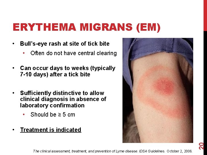 ERYTHEMA MIGRANS (EM) • Bull’s-eye rash at site of tick bite • Often do