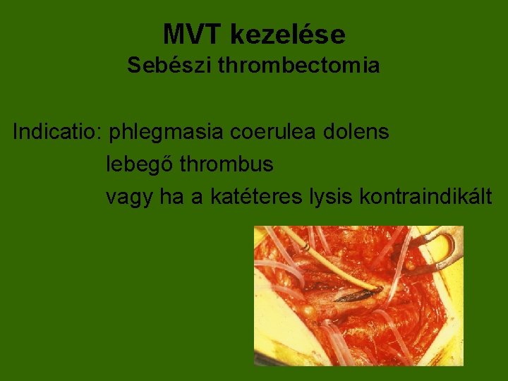 MVT kezelése Sebészi thrombectomia Indicatio: phlegmasia coerulea dolens lebegő thrombus vagy ha a katéteres