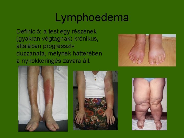 Lymphoedema Definició: a test egy részének (gyakran végtagnak) krónikus, általában progresszív duzzanata, melynek hátterében