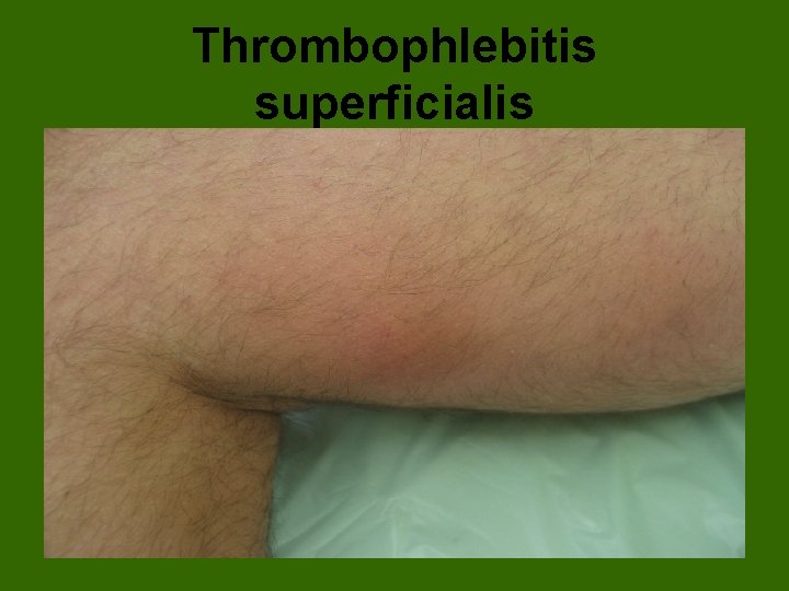 Thrombophlebitis superficialis 