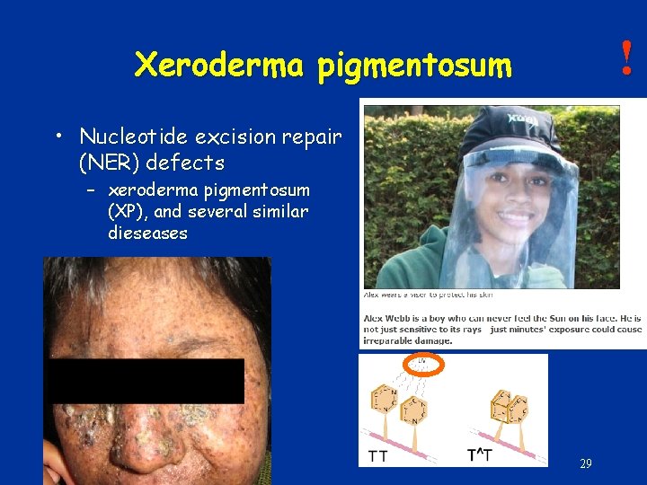 ! Xeroderma pigmentosum • Nucleotide excision repair (NER) defects – xeroderma pigmentosum (XP), and