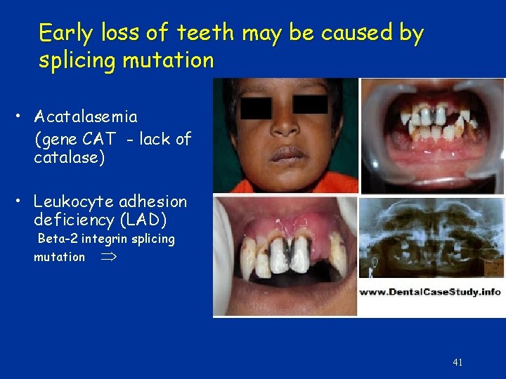 Early loss of teeth may be caused by splicing mutation • Acatalasemia (gene CAT