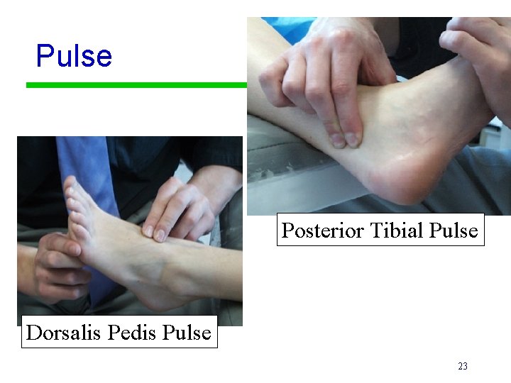 Pulse Posterior Tibial Pulse Dorsalis Pedis Pulse 23 