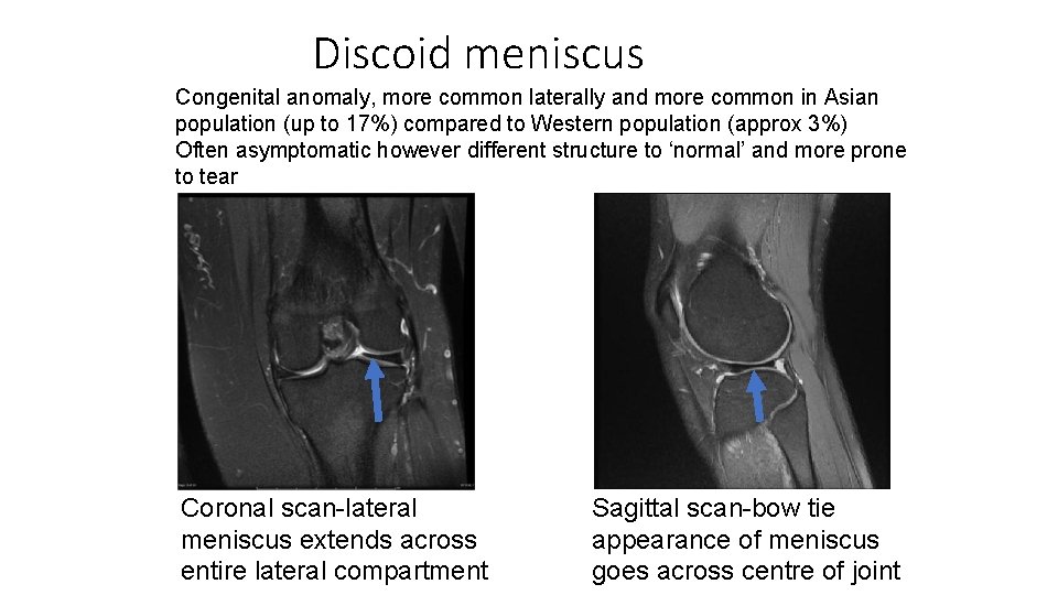 Discoid meniscus Congenital anomaly, more common laterally and more common in Asian population (up