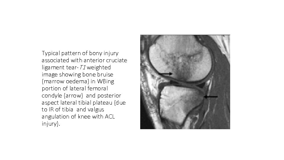 Typical pattern of bony injury associated with anterior cruciate ligament tear-T 1 weighted image
