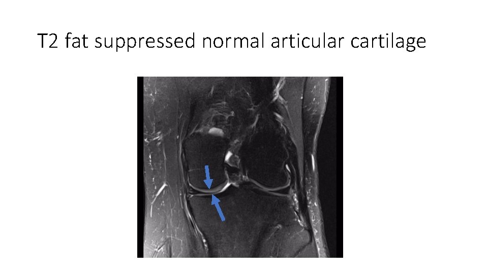 T 2 fat suppressed normal articular cartilage 