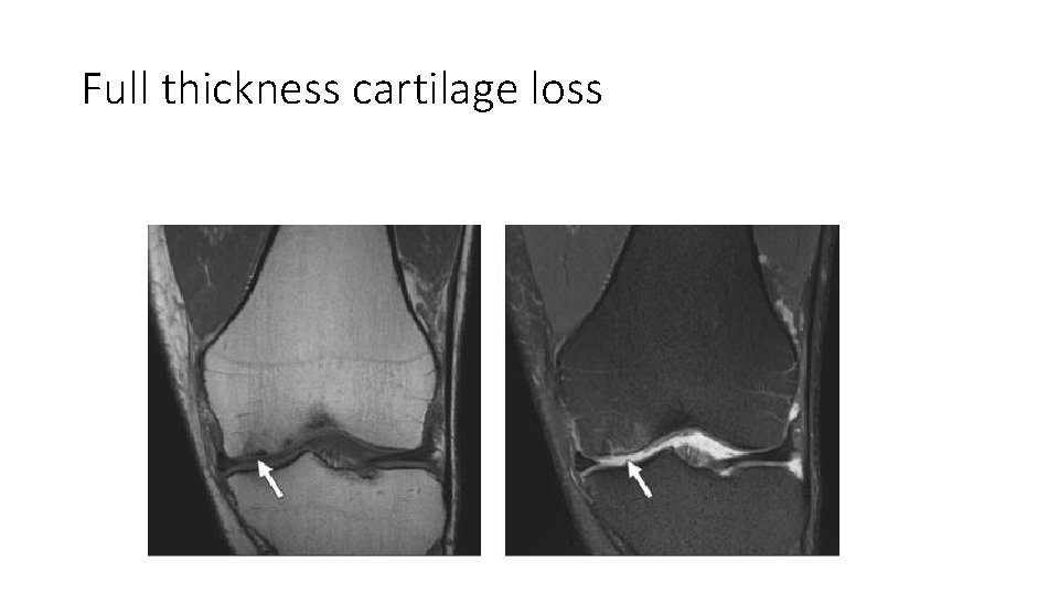 Full thickness cartilage loss 