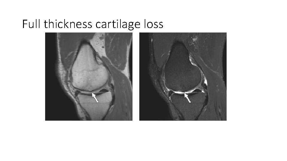 Full thickness cartilage loss 