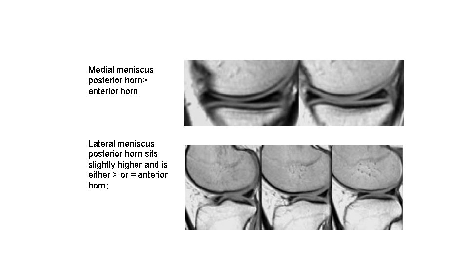Medial meniscus posterior horn> anterior horn Lateral meniscus posterior horn sits slightly higher and