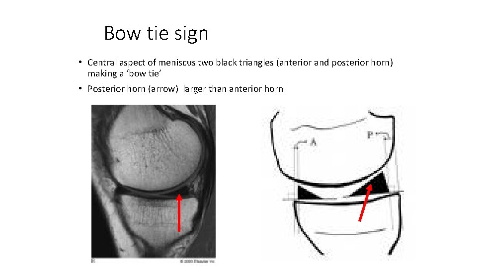 Bow tie sign • Central aspect of meniscus two black triangles (anterior and posterior