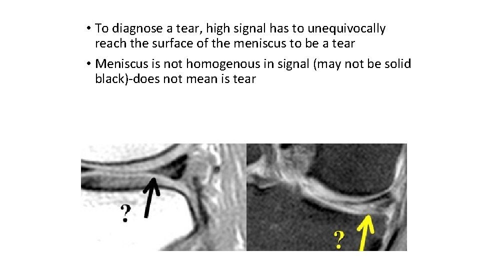  • To diagnose a tear, high signal has to unequivocally reach the surface