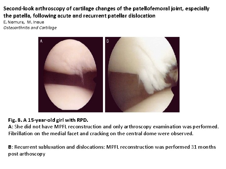 Second-look arthroscopy of cartilage changes of the patellofemoral joint, especially the patella, following acute