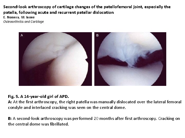 Second-look arthroscopy of cartilage changes of the patellofemoral joint, especially the patella, following acute