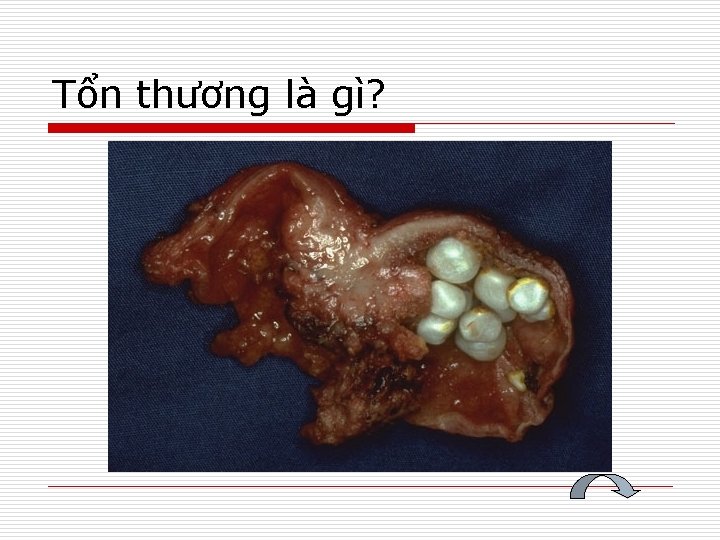 Tổn thương là gì? 