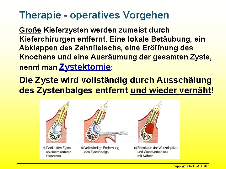 Therapie - operatives Vorgehen Große Kieferzysten werden zumeist durch Kieferchirurgen entfernt. Eine lokale Betäubung,