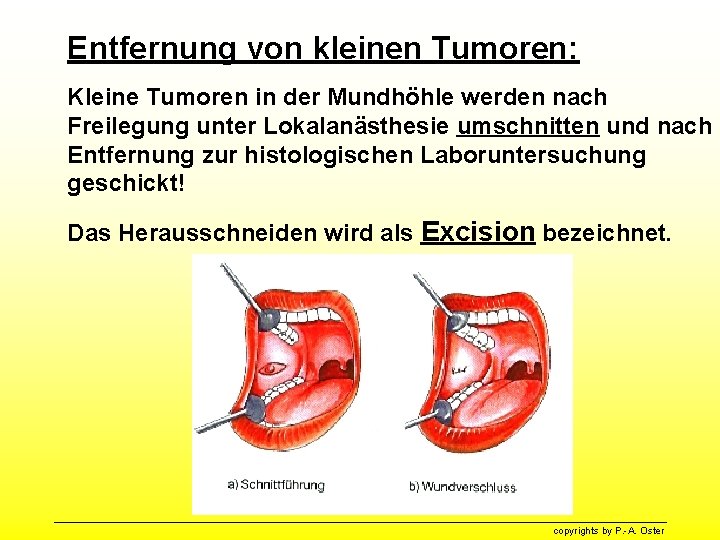 Entfernung von kleinen Tumoren: Kleine Tumoren in der Mundhöhle werden nach Freilegung unter Lokalanästhesie