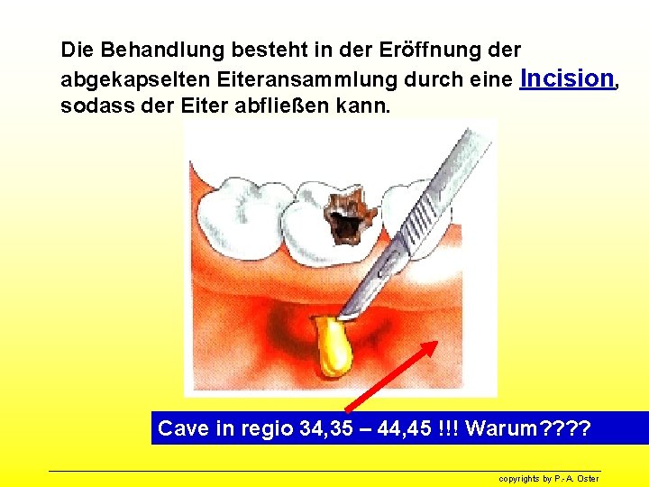 Die Behandlung besteht in der Eröffnung der abgekapselten Eiteransammlung durch eine Incision, sodass der