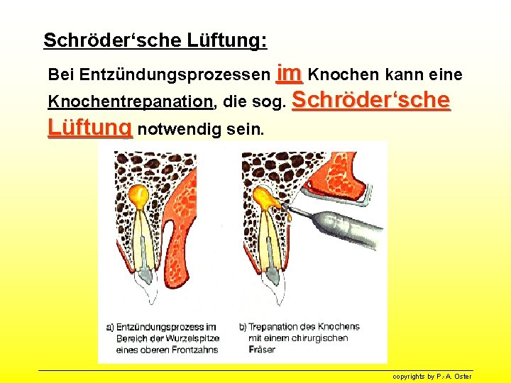 Schröder‘sche Lüftung: Bei Entzündungsprozessen im Knochen kann eine Knochentrepanation, die sog. Schröder‘sche Lüftung notwendig