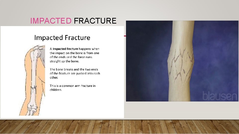IMPACTED FRACTURE 