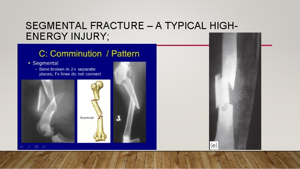 SEGMENTAL FRACTURE – A TYPICAL HIGHENERGY INJURY; 